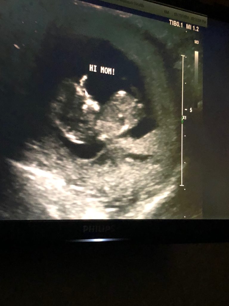 Ultrasound of the baby
